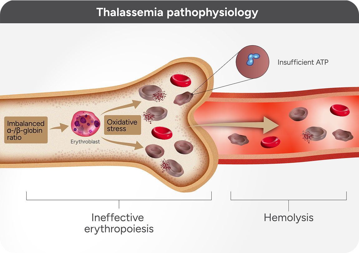 Thalassemia mechanism of disease illustration