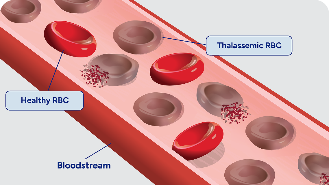 Image showing thalassemic RBCs in the blood stream breaking down early