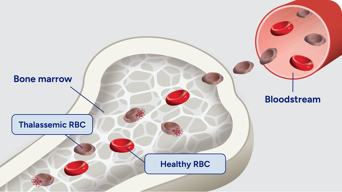Image showing thalassemic red blood cells breaking down early, before leaving the bone marrow